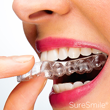 suresmile aligners